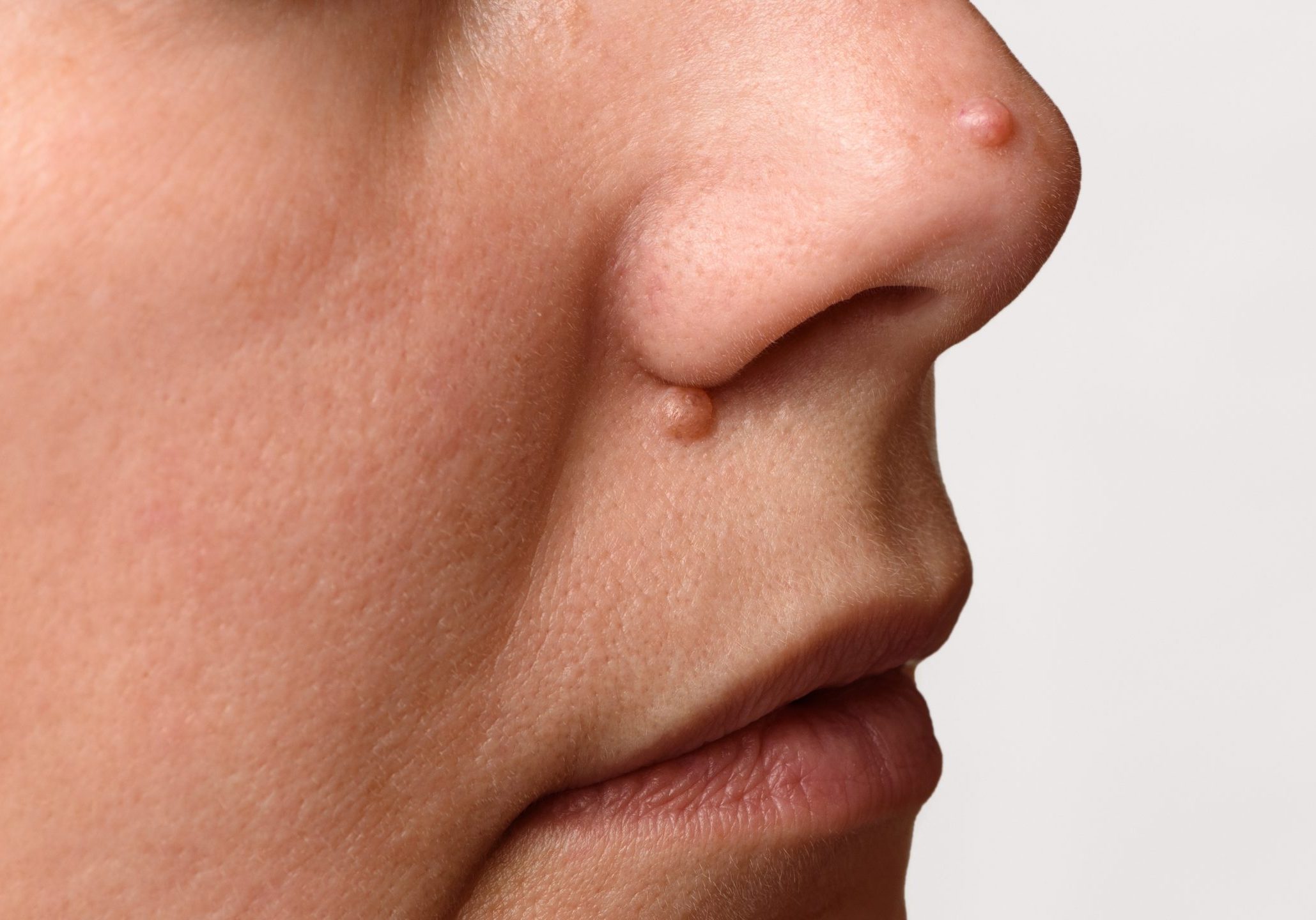 Closeup,Of,Two,Big,Moles,Or,Nevus,On,Face.,Nevi