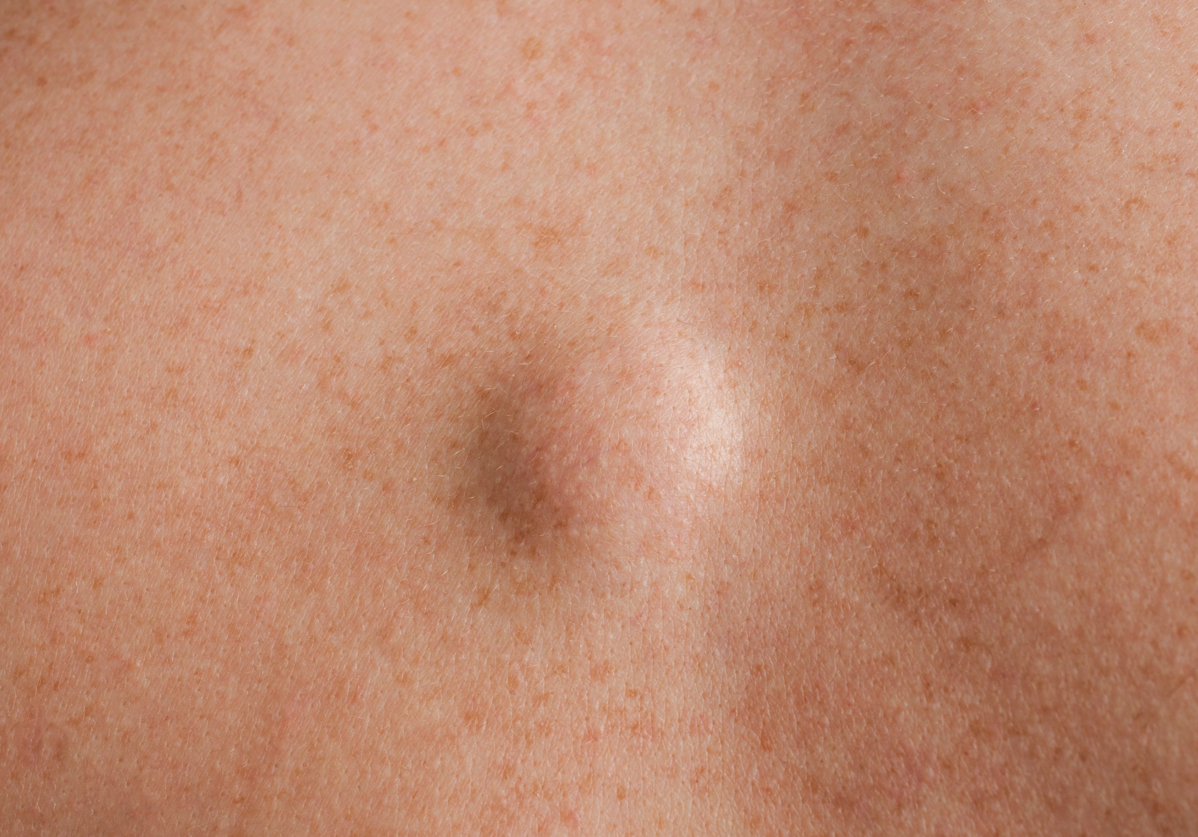 Lipoma,Close,Up,Shot,On,The,Back,Of,A,Caucasian